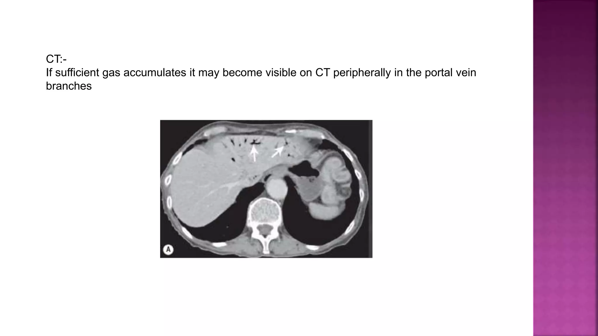 CT:-
If sufficient gas accumulates it may become visible on CT peripherally in the portal vein
branches
 