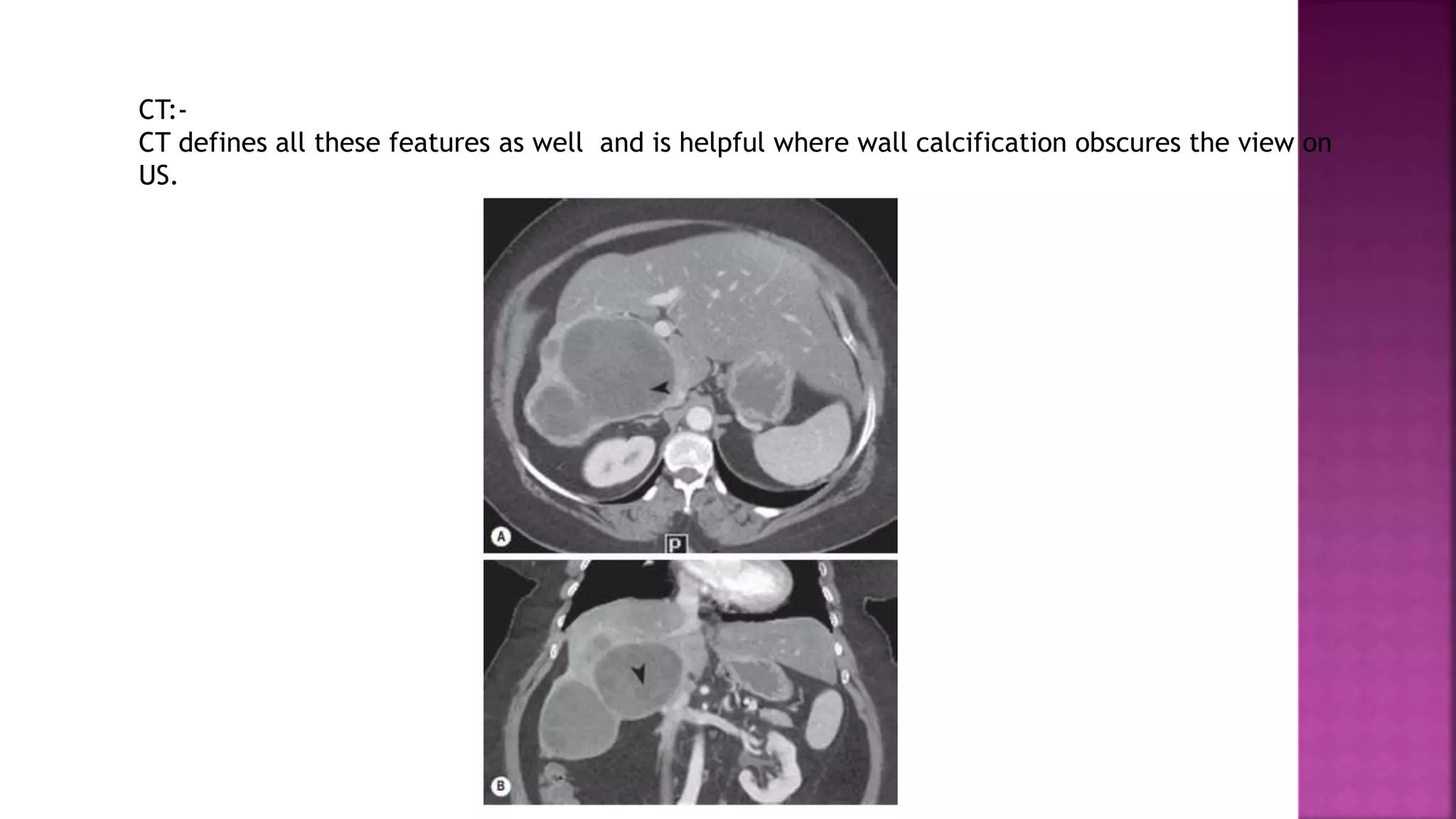 CT:-
CT defines all these features as well and is helpful where wall calcification obscures the view on
US.
 