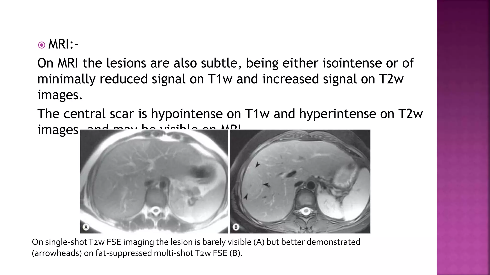  MRI:-
On MRI the lesions are also subtle, being either isointense or of
minimally reduced signal on T1w and increased signal on T2w
images.
The central scar is hypointense on T1w and hyperintense on T2w
images, and may be visible on MRI .
On single-shotT2w FSE imaging the lesion is barely visible (A) but better demonstrated
(arrowheads) on fat-suppressed multi-shotT2w FSE (B).
 