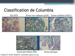 Classification de Columbia
           Tip (TIP)           Forme avec collapsus (COL)   Forme cellulaire (CELL)




                    Forme péri-hilaire (PH)        Forme classique
D'Agati V. Semin Nephrol. 2003 Mar;23(2):117-34
 