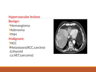 Hypervascular lesions
Benign:

Hemangioma

Adenoma

FNH
Malignant:

HCC

Metastases(RCC,carcinoi
d,thyroid
ca,NET,sarcoma)
 