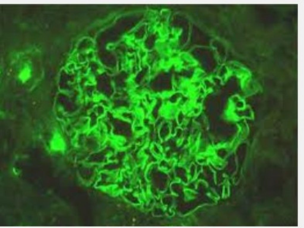 Focal Segmental Glomerulosclerosis