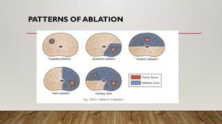 PATTERNS OF ABLATION
 