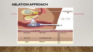 ABLATION APPROACH
 