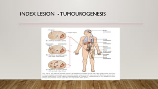 INDEX LESION - TUMOUROGENESIS
 
