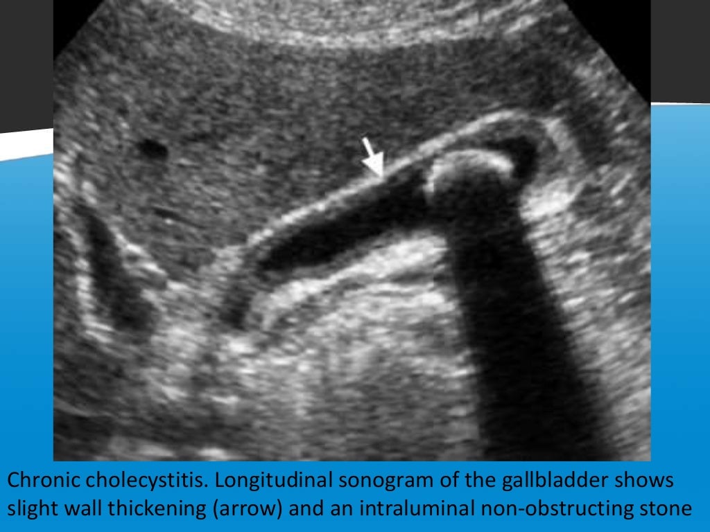 Focal vs diffuse gall bladder wall thickening