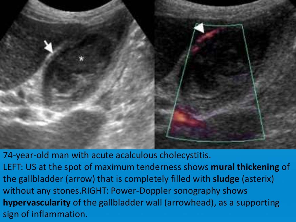 Focal vs diffuse gall bladder wall thickening