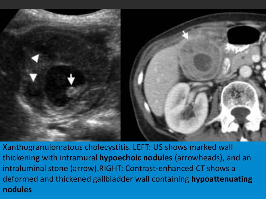 Focal vs diffuse gall bladder wall thickening