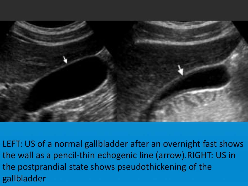 Focal vs diffuse gall bladder wall thickening