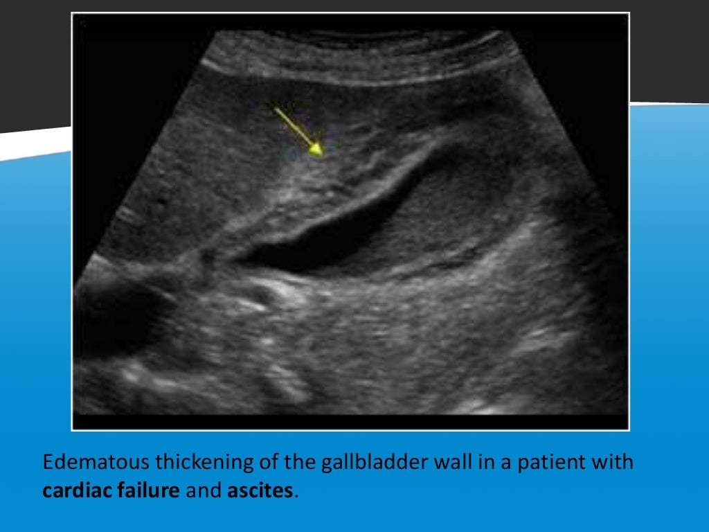 Focal vs diffuse gall bladder wall thickening