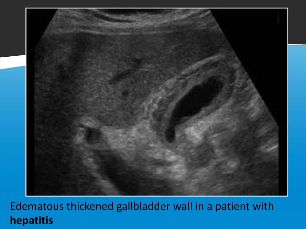 Focal vs diffuse gall bladder wall thickening