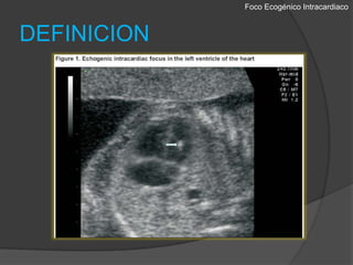 Foco EcogénicoIntracardiacoDEFINICION