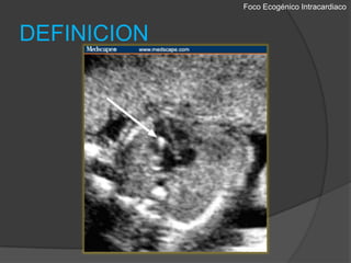 Foco EcogénicoIntracardiacoDEFINICION