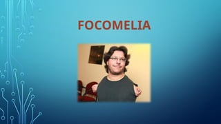 Focomelia Rx Estimulación temprana infantil Focomelia - Discapacidad motora | PPTX