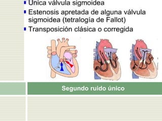 Segundo ruido único
 