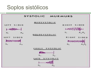 Soplos sistólicos
 