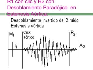 R1 con clic y R2 con
Desoblamiento Paradójico en
Estenosis Aórtica:
 