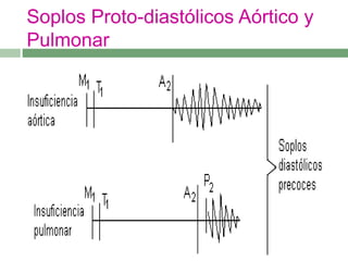 Soplos Proto-diastólicos Aórtico y
Pulmonar
 