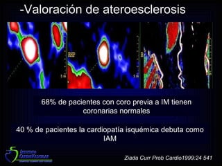 68% de pacientes con coro previa a IM tienen coronarias normales Ziada Curr Prob Cardio1999:24 541 40 % de pacientes la cardiopatía isquémica debuta como IAM -Valoración de ateroesclerosis 