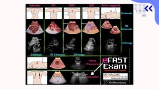 Focus assessment with sonography in trauma fast- | PPTX