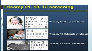 FETAL ANEUPLOIDY
Fetal aneuploidy refers to the abnormal number of chromosomes,
other than usual diploid complement of 46 chromosomes .
TRISOMY : Presence of single additional chromosome, known as trisomy, is
an important cause of congenital malformations. The most common
autosomal trisomies are Down syndrome ( Trisomy 21) , Edward’s
syndrome ( trisomy 18) and Patau syndrome ( Trisomy 13).
Trisomy 21 is the most common of them and one of the most important
cause of congenital mental retardation, affecting approx. 1:800 to 1 :900
live births .
Trisomy 18 & 13 are considered lethal malformation with 95% trisomy 18
infants dying with in 1 yr of age and trisomy 13 infants dying within 3 mths
of age.
Incidence of trisomy 18 ~ 1:3000 live births
Incidence of trisomy 13 ~ 1:5000 live births
Antenatal sonographic based screening is
able to detect over 90% of cases of trisomy
21, trisomy 18 and trisomy 13.
 