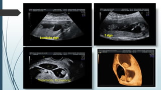 Lambda sign
T sign
Triamniotic trichorionic
 