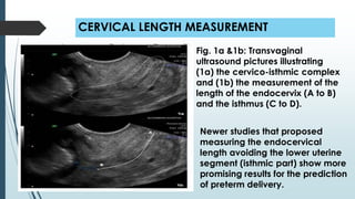 CERVICAL LENGTH MEASUREMENT
Newer studies that proposed
measuring the endocervical
length avoiding the lower uterine
segment (isthmic part) show more
promising results for the prediction
of preterm delivery.
Fig. 1a &1b: Transvaginal
ultrasound pictures illustrating
(1a) the cervico-isthmic complex
and (1b) the measurement of the
length of the endocervix (A to B)
and the isthmus (C to D).
 