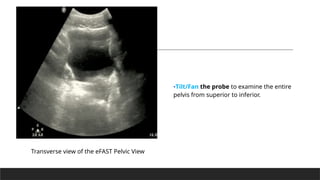 E Fast View Focused Assessment with Sonography for Trauma (FAST.pptx