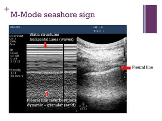 Focused thoracic ultrasound | PDF