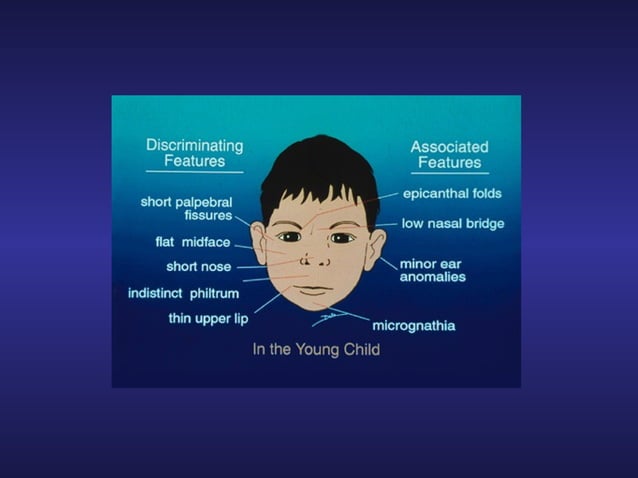 Foetal Alcohol Syndrome | PPT
