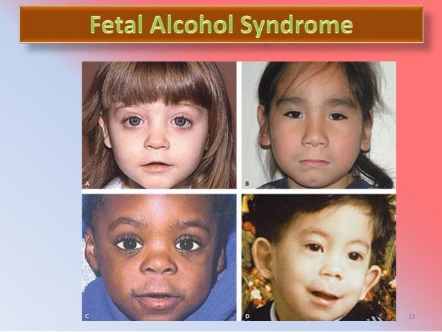 the physical characteristics of fetal alcohol syndrome Fetal alcohol syndrome (fas) definition, causes, short/long-term effects in babies, signs, facial features (eyes, nose), treatment, statistics, pictures. the physical characteristics of fetal alcohol syndrome Fetal alcohol syndrome (fas) definition, causes, short/long-term effects in babies, signs, facial features (eyes, nose), treatment, statistics, pictures.