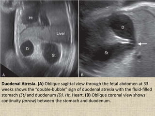 Duodenal Atresia. (A) Oblique sagittal view through the fetal abdomen at 33
weeks shows the “double-bubble” sign of duodenal atresia with the fluid-filled
stomach (St) and duodenum (D). Ht, Heart. (B) Oblique coronal view shows
continuity (arrow) between the stomach and duodenum.
 
