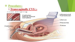  Procedure:-
1.Transvaginally CVS :-
 