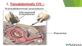 2. Transabdominally CVS :-
 