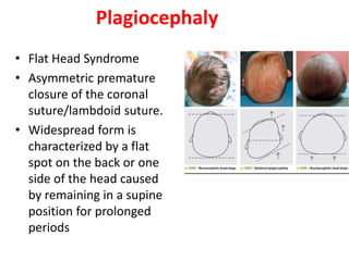 Plagiocephaly
• Flat Head Syndrome
• Asymmetric premature
closure of the coronal
suture/lambdoid suture.
• Widespread form is
characterized by a flat
spot on the back or one
side of the head caused
by remaining in a supine
position for prolonged
periods
 