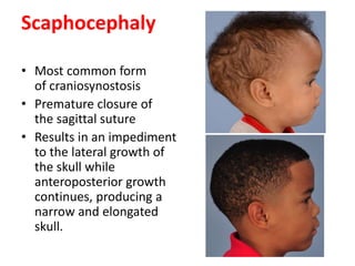 Scaphocephaly
• Most common form
of craniosynostosis
• Premature closure of
the sagittal suture
• Results in an impediment
to the lateral growth of
the skull while
anteroposterior growth
continues, producing a
narrow and elongated
skull.
 