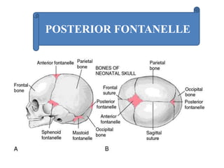 POSTERIOR FONTANELLE
 