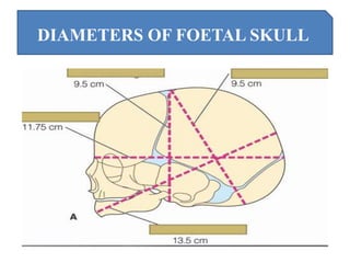 DIAMETERS OF FOETAL SKULL
 