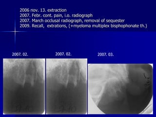 Complication of tooth extraction | PDF