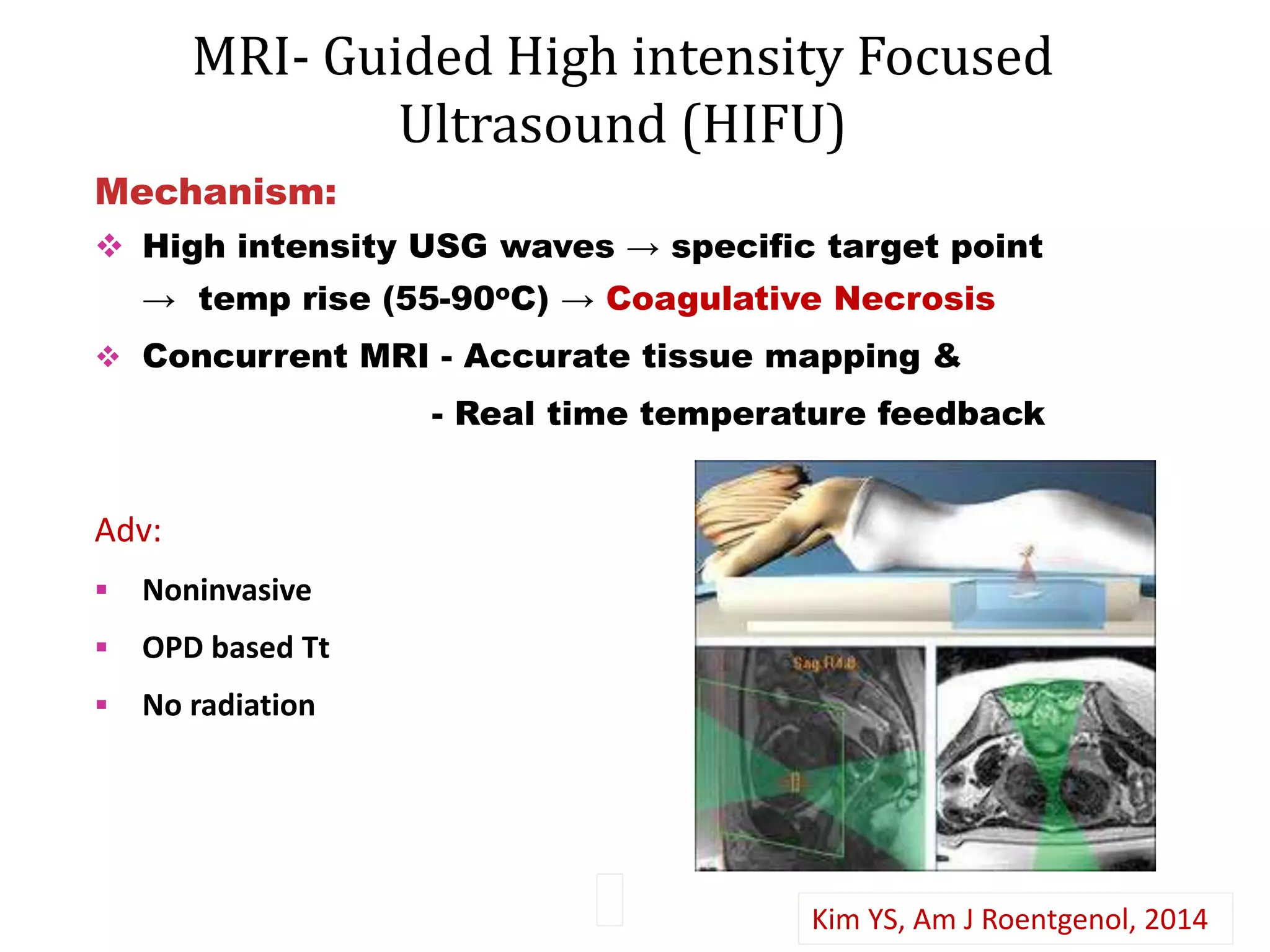 MRI- Guided High intensity Focused
Ultrasound (HIFU)
Mechanism:
 High intensity USG waves → specific target point
→ temp rise (55-90oC) → Coagulative Necrosis
 Concurrent MRI - Accurate tissue mapping &
- Real time temperature feedback
Adv:
 Noninvasive
 OPD based Tt
 No radiation
Kim YS, Am J Roentgenol, 2014
 