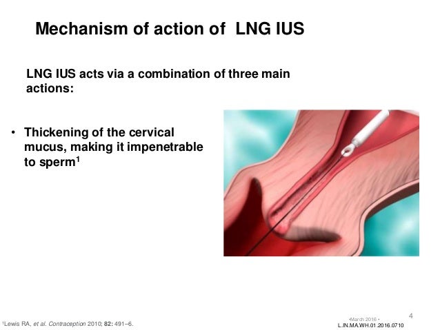 Levonorgestrel Intrauterine System (Ius)