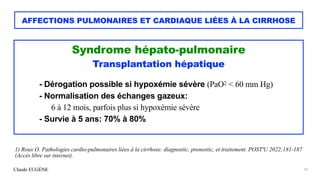Claude EUGÈNE
AFFECTIONS PULMONAIRES ET CARDIAQUE LIÉES À LA CIRRHOSE
Syndrome hépato-pulmonaire


Transplantation hépatiq...