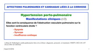 Claude EUGÈNE
AFFECTIONS PULMONAIRES ET CARDIAQUE LIÉES À LA CIRRHOSE
Hypertension porto-pulmonaire


Manifestations clini...