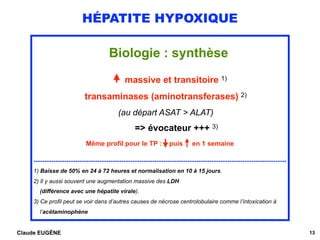 HÉPATITE HYPOXIQUE
Biologie : synthèse
 
massive et transitoire 1)
transaminases (aminotransferases) 2)
(au départ ASAT > ...