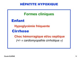 HÉPATITE HYPOXIQUE
Formes cliniques
Enfant
Hypoglycémie fréquente
Cirrhose
Choc hémorragique et/ou septique 
(+/- « cardio...