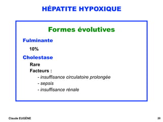 HÉPATITE HYPOXIQUE
Formes évolutives
Fulminante 
10%
Cholestase
Rare 
Facteurs :  
- insuffisance circulatoire prolongée 
...