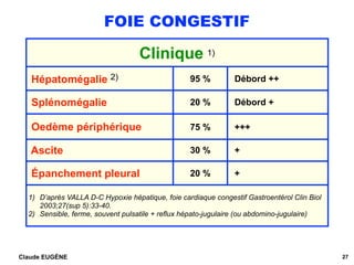 FOIE CONGESTIF
Claude EUGÈNE 27
Clinique 1)
Hépatomégalie 2) 95 % Débord ++
Splénomégalie 20 % Débord +
Oedème périphérique 75 % +++
Ascite 30 % +
Épanchement pleural 20 % +
1) D’après VALLA D-C Hypoxie hépatique, foie cardiaque congestif Gastroentérol Clin Biol
2003;27(sup 5):33-40.
2) Sensible, ferme, souvent pulsatile + reflux hépato-jugulaire (ou abdomino-jugulaire)
 