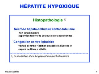 HÉPATITE HYPOXIQUE
Histopathologie 1)
Nécrose hépato-cellulaire centro-lobulaire 
non inflammatoire 
apparition tardive de...