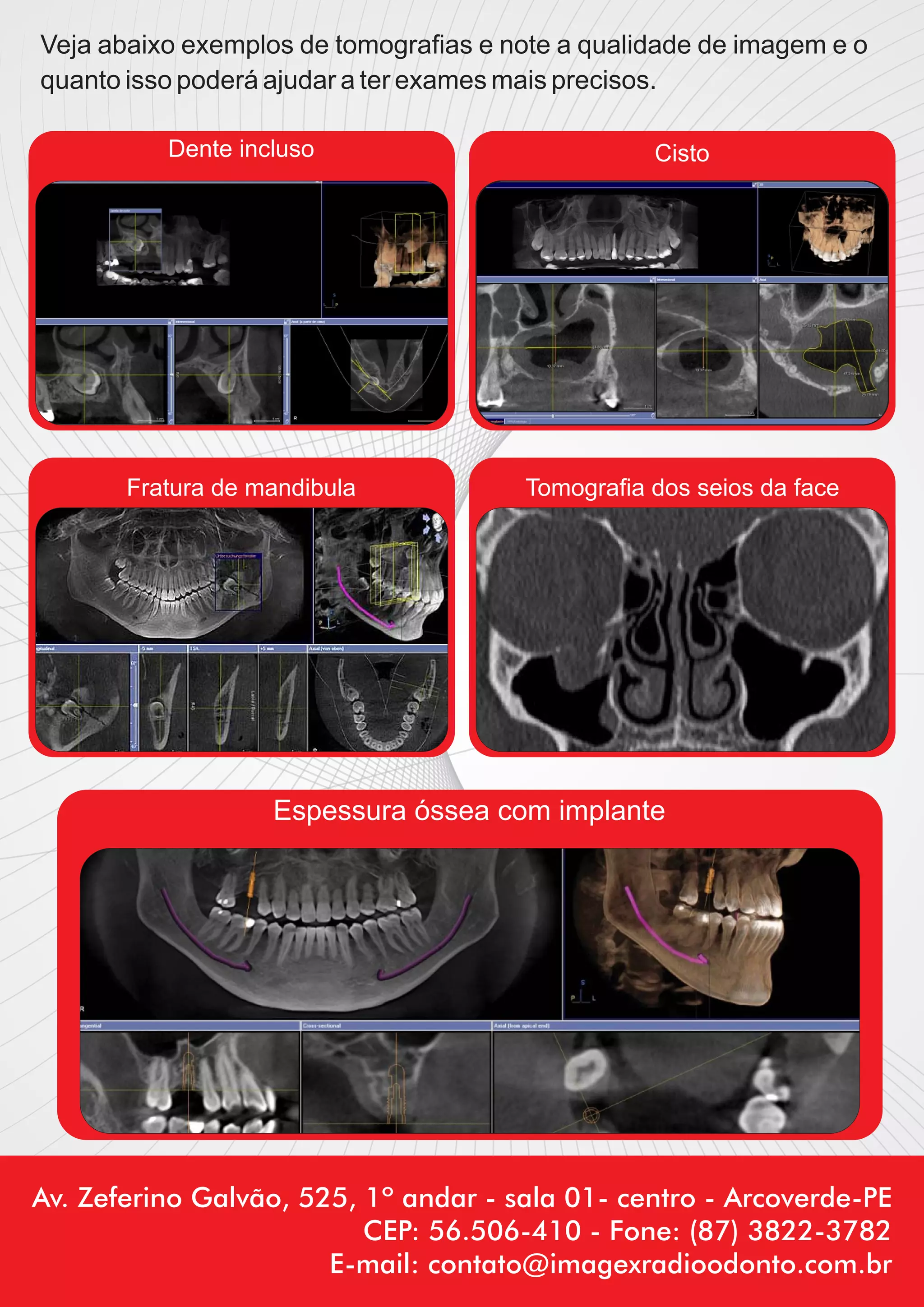 Veja abaixo exemplos de tomograﬁas e note a qualidade de imagem e o
quanto isso poderá ajudar a ter exames mais precisos.

          Dente incluso                           Cisto




       Fratura de mandibula            Tomograﬁa dos seios da face




                   Espessura óssea com implante




Av. Zeferino Galvão, 525, 1º andar - sala 01- centro - Arcoverde-PE
                          CEP: 56.506-410 - Fone: (87) 3822-3782
                       E-mail: contato@imagexradioodonto.com.br
 