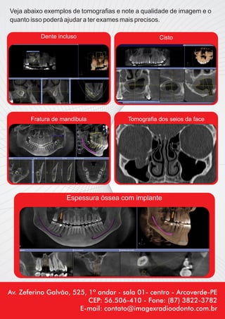 Veja abaixo exemplos de tomograﬁas e note a qualidade de imagem e o
quanto isso poderá ajudar a ter exames mais precisos.

          Dente incluso                           Cisto




       Fratura de mandibula            Tomograﬁa dos seios da face




                   Espessura óssea com implante




Av. Zeferino Galvão, 525, 1º andar - sala 01- centro - Arcoverde-PE
                          CEP: 56.506-410 - Fone: (87) 3822-3782
                       E-mail: contato@imagexradioodonto.com.br
 